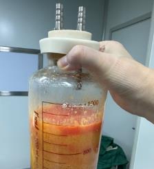 青岛水动力吸脂手术要做多久？